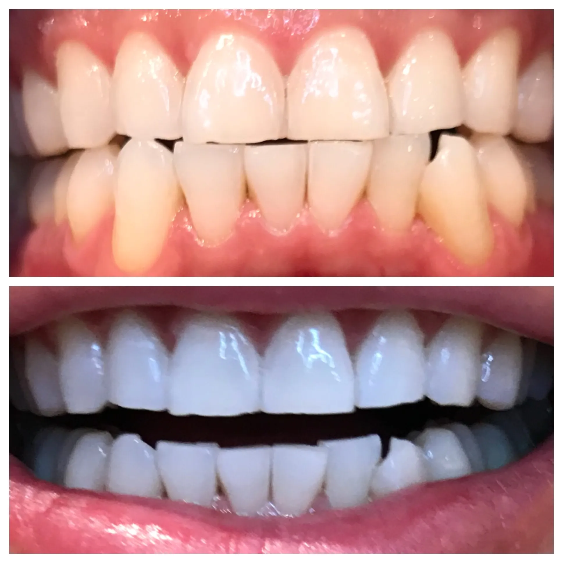 30920 oso white teeth whitening stain removal