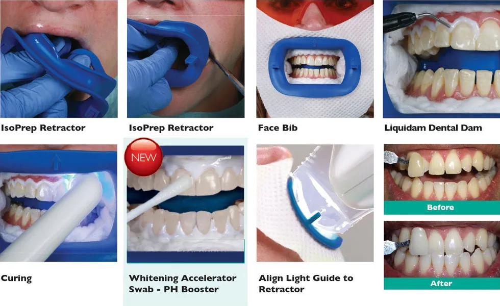 30921 ideal candidate teeth whitening