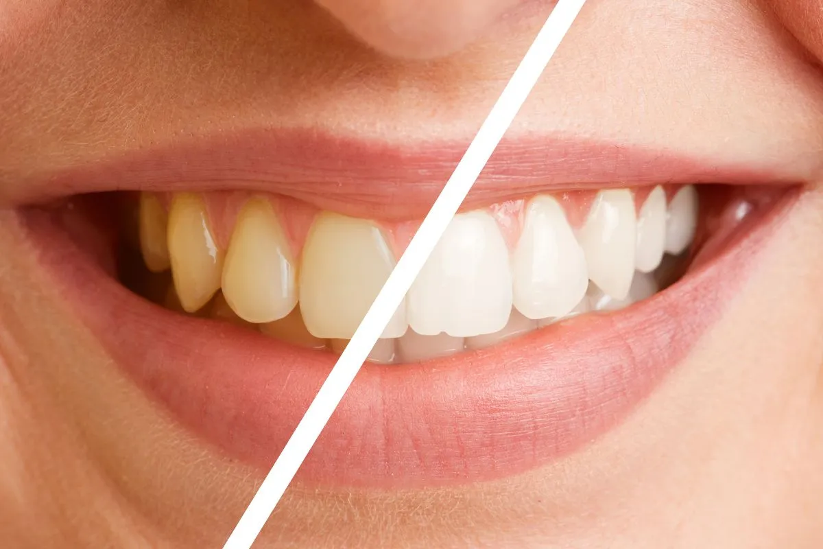 30921 teeth whitening options
