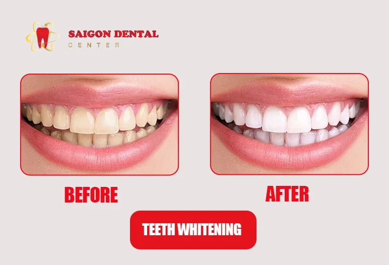 30922 teeth whitening results