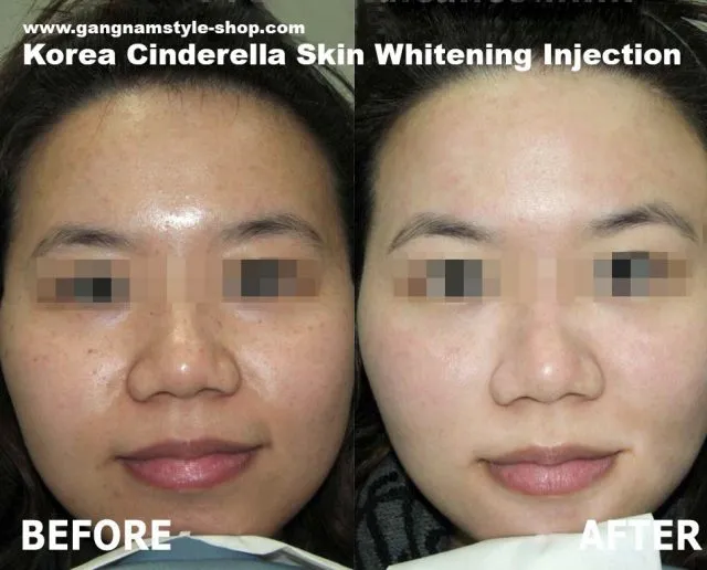30926 skin whitening before after