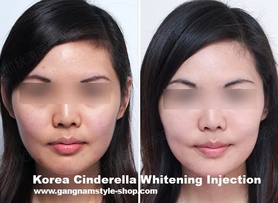 30926 whitening injection procedure