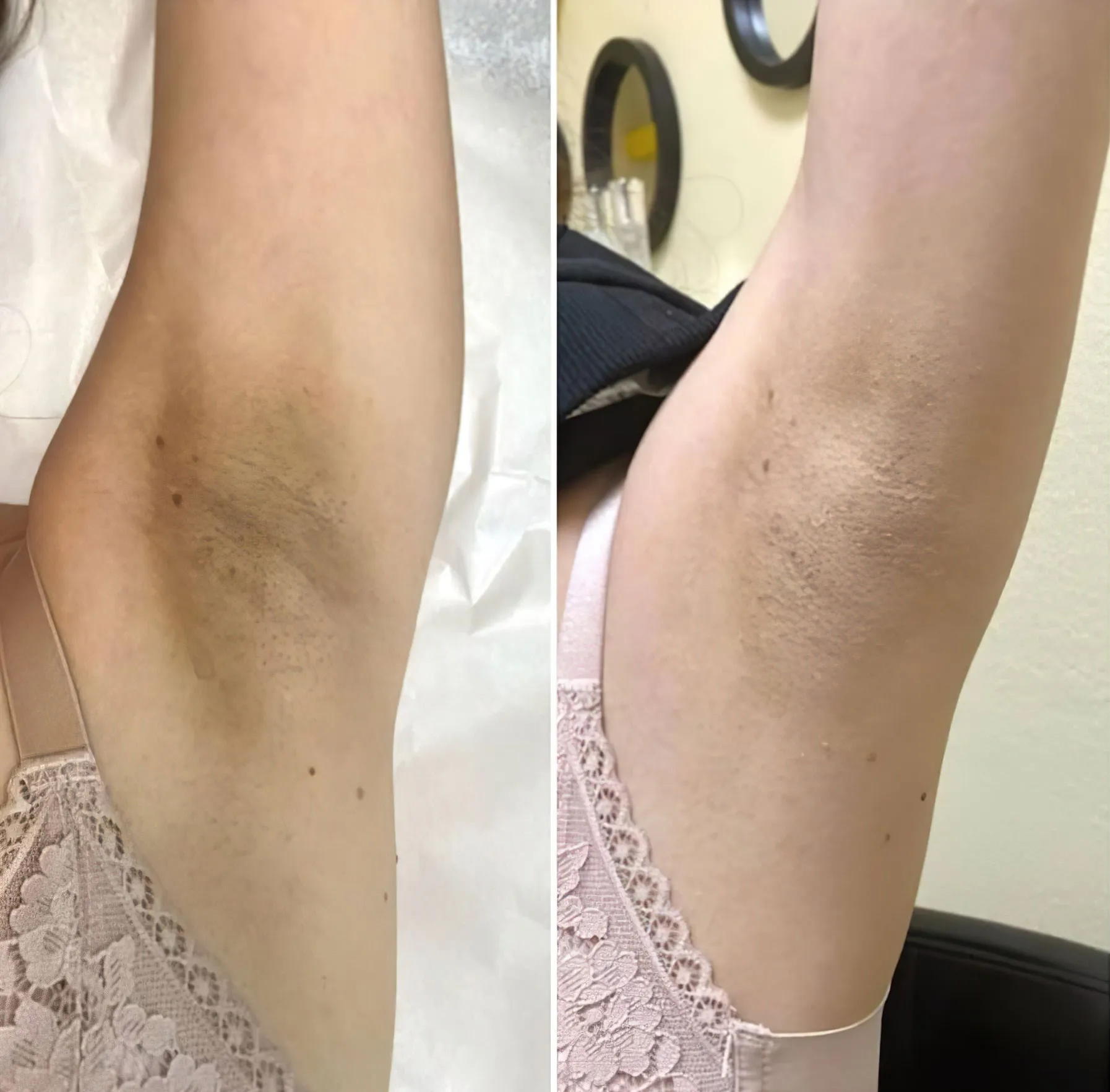 30927 laser underarm whitening