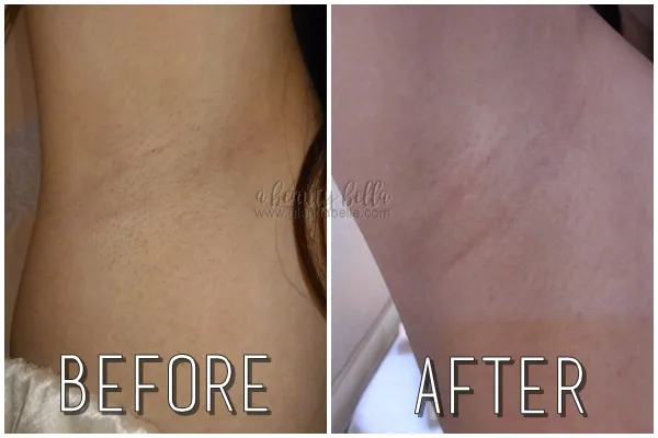 30927 underarm pigmentation