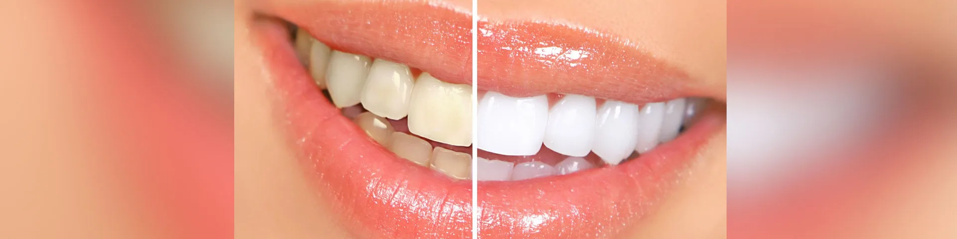 30934 teeth whitening gilbert az