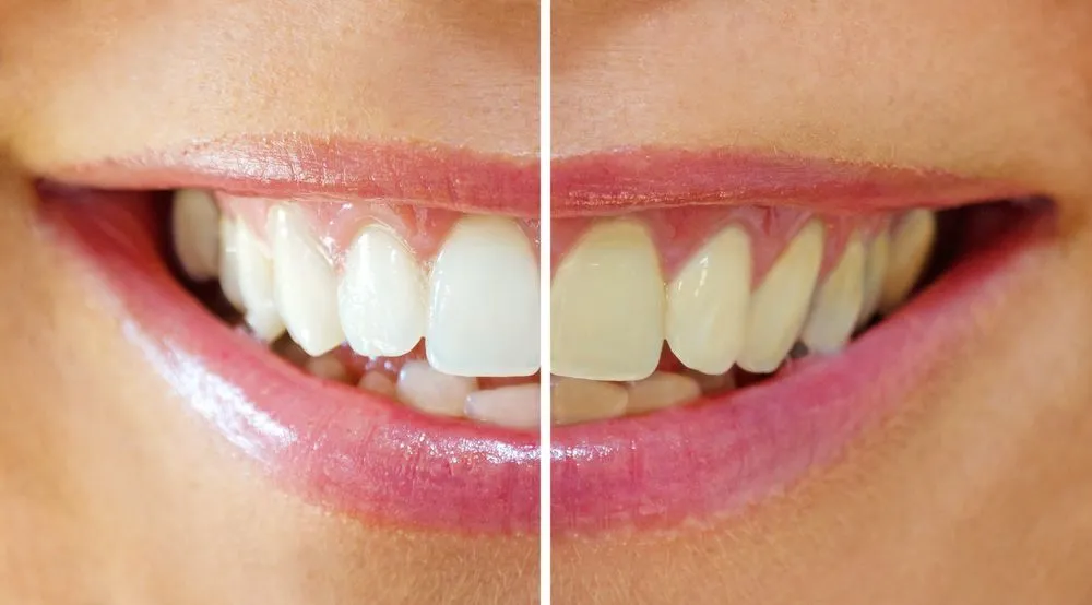30934 tooth discoloration
