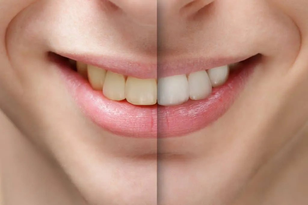 30935 teeth whitening chula vista before after