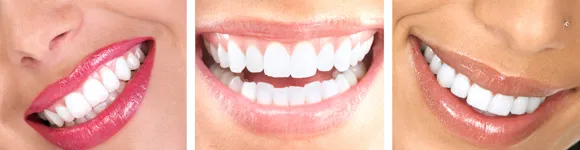 30935 teeth whitening chula vista confident smile