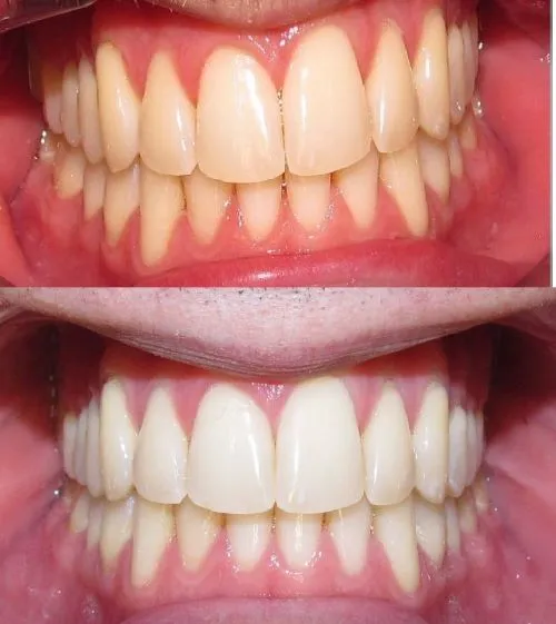 30935 teeth whitening chula vista take home kit