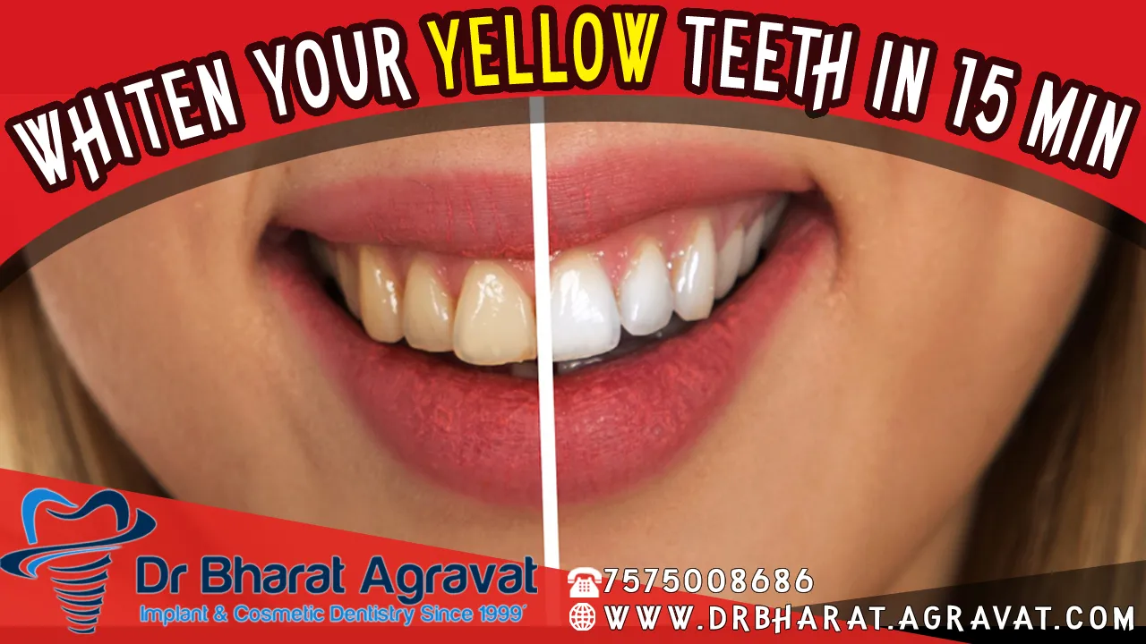 30942 fasting teeth whitening alternatives