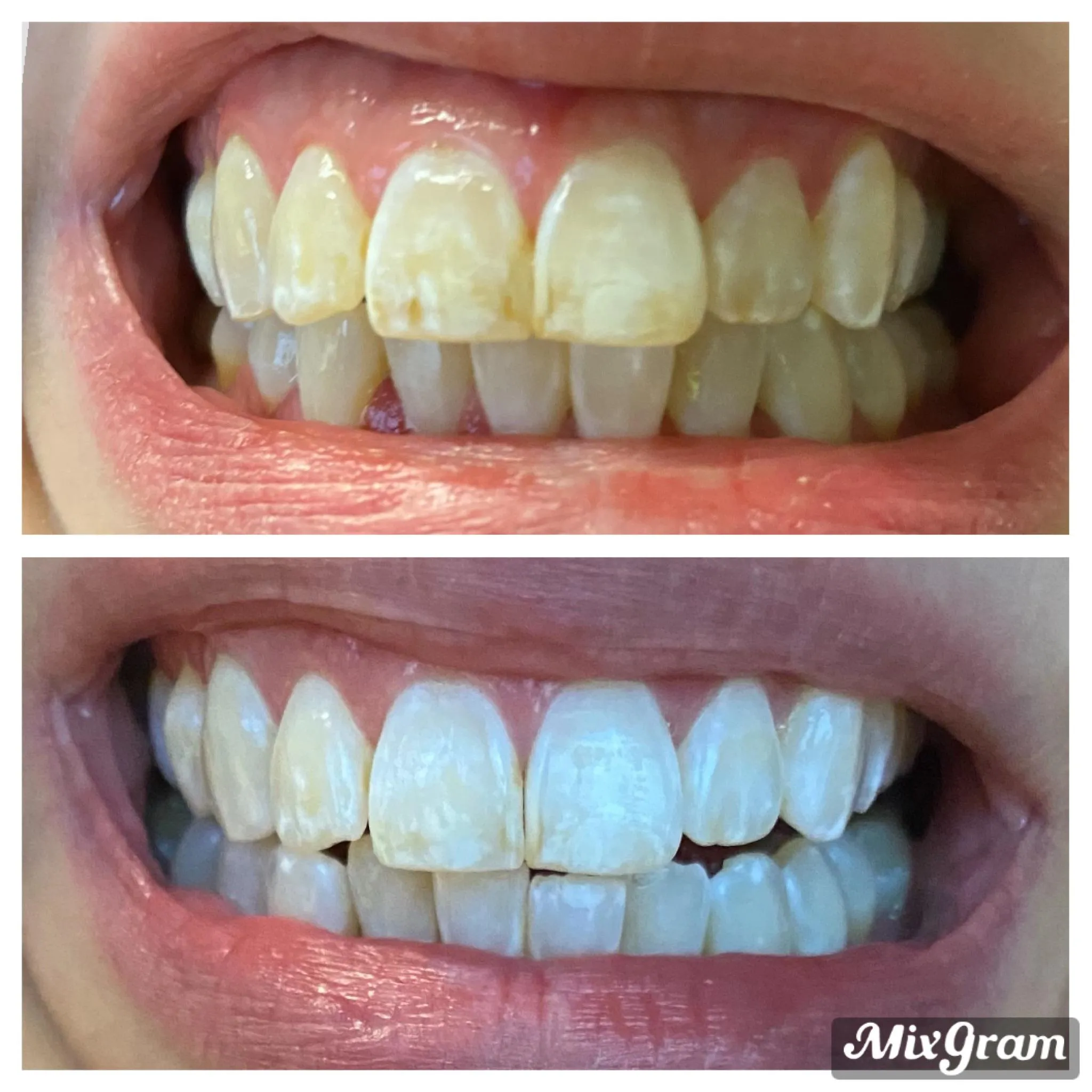 30945 maintaining teeth whitening