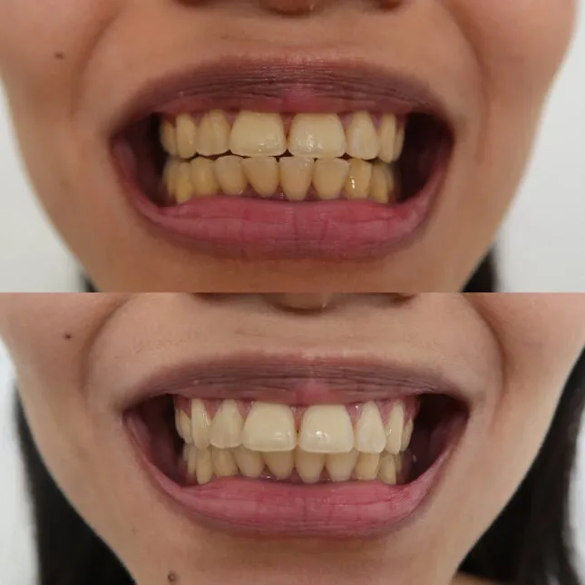 30960 teeth whitening at home