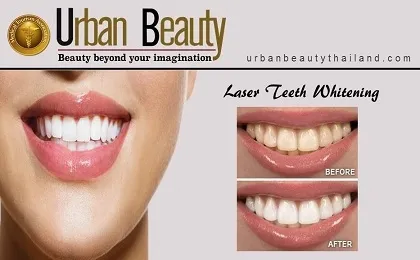 30960 teeth whitening before after