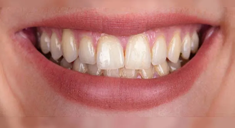 30979 professional teeth whitening