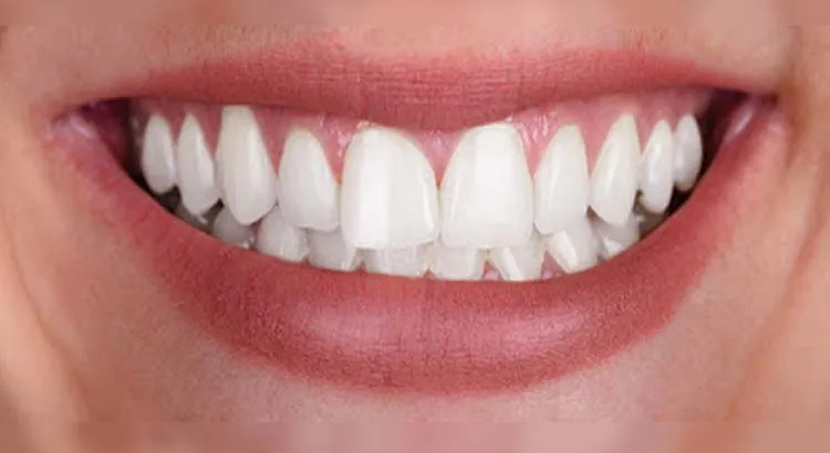 30979 tooth discoloration