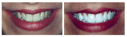 30979 whitening toothpaste