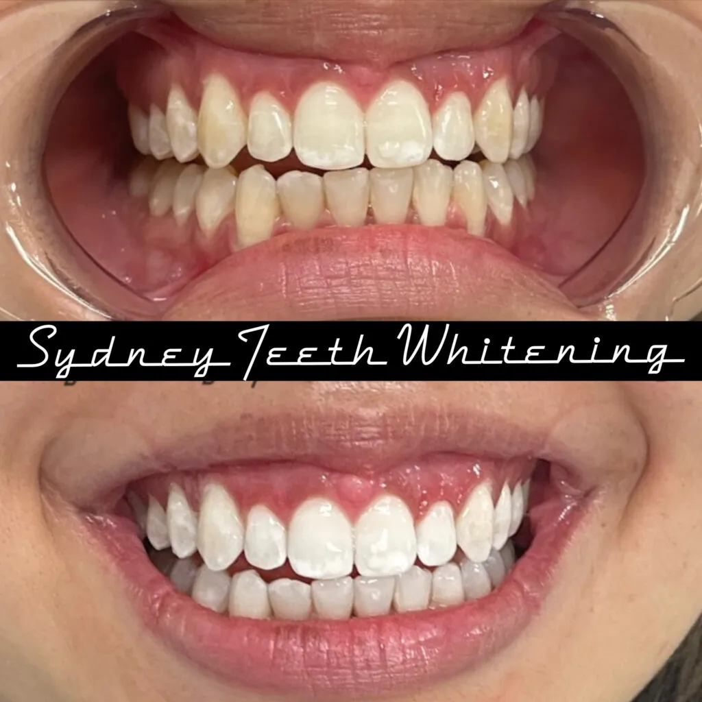 30981 enamel and whitening