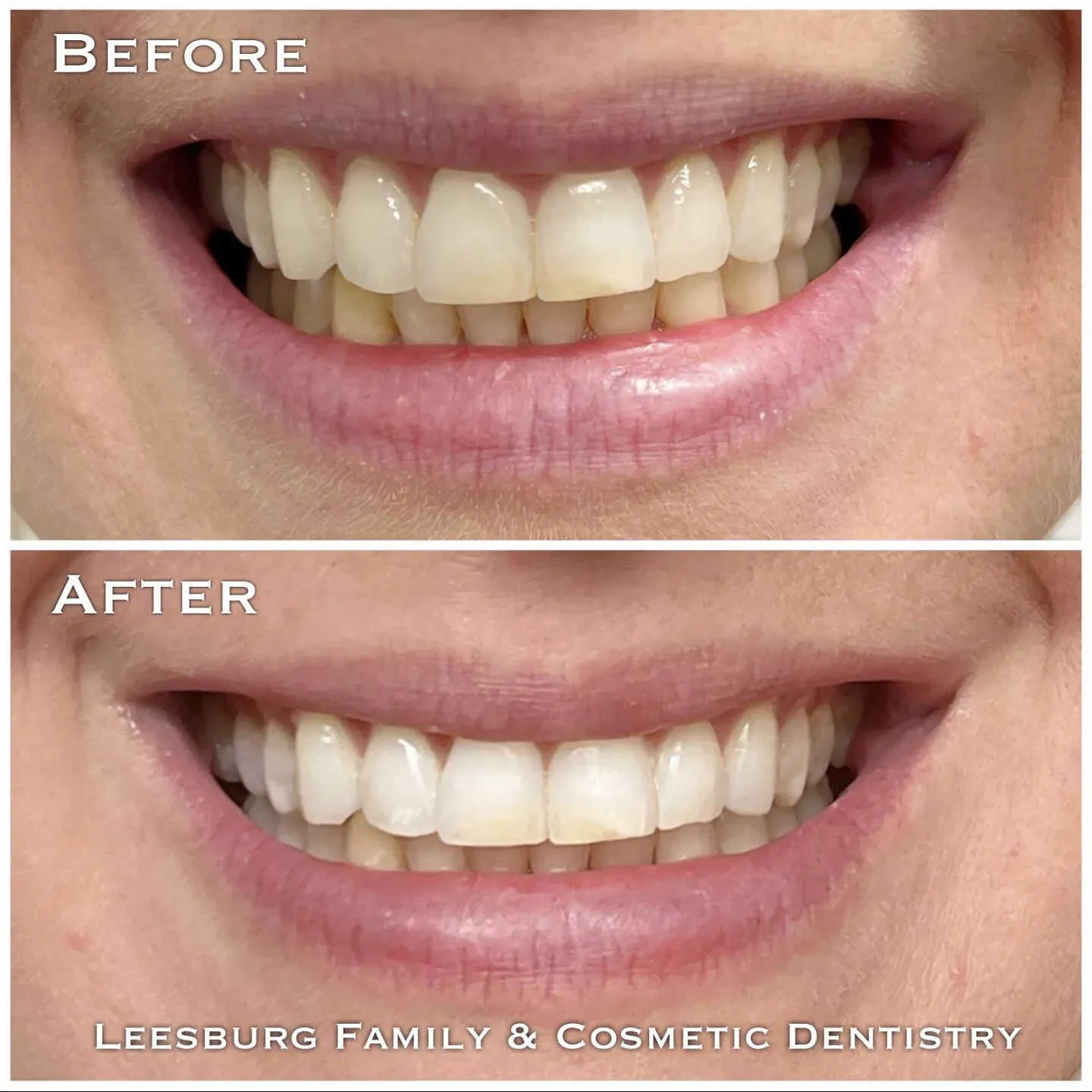 30995 teeth whitening leesburg va main