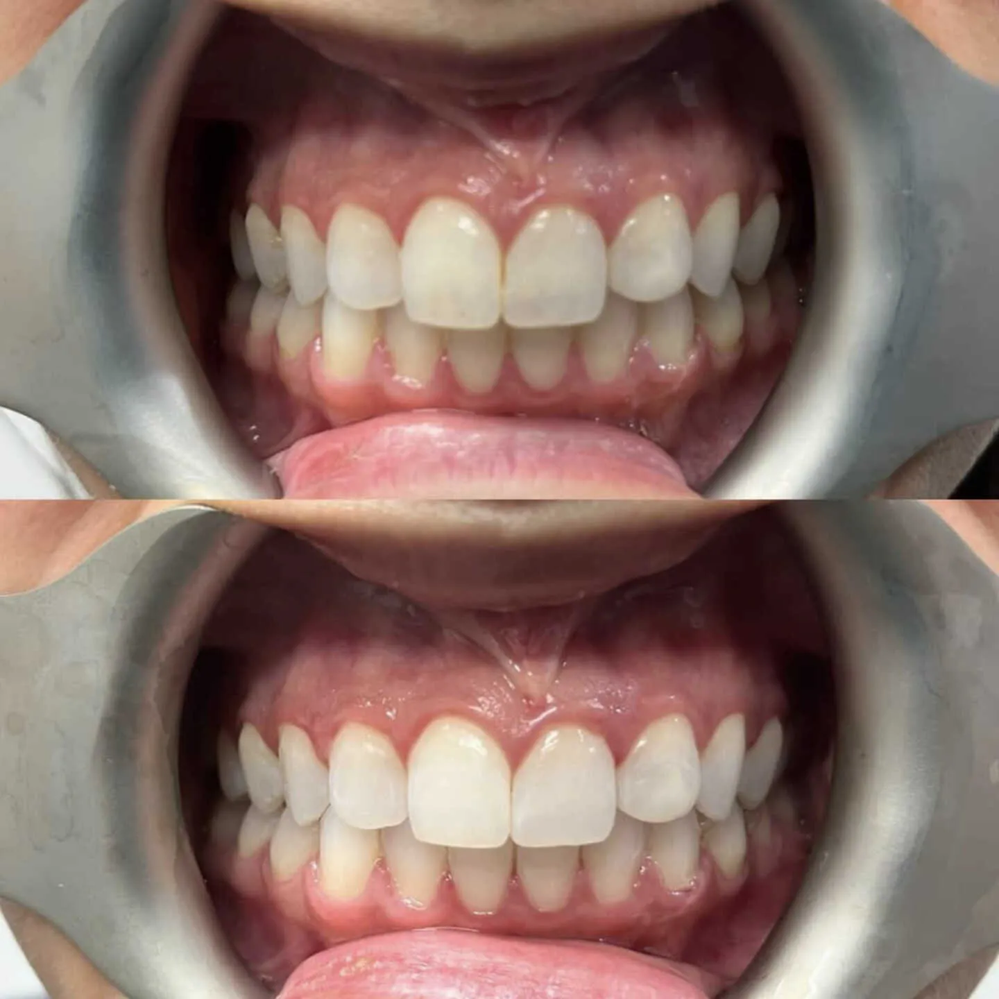 30995 teeth whitening professional