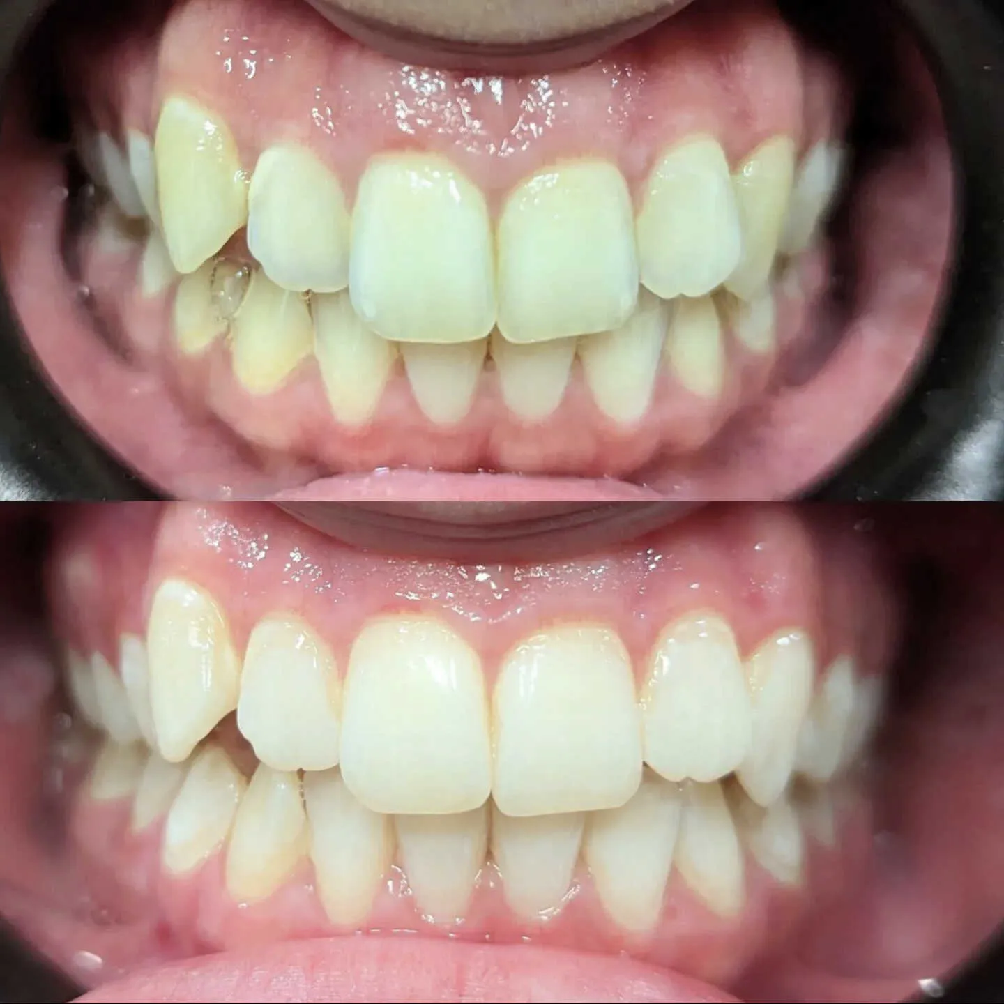 30995 teeth whitening take home kit