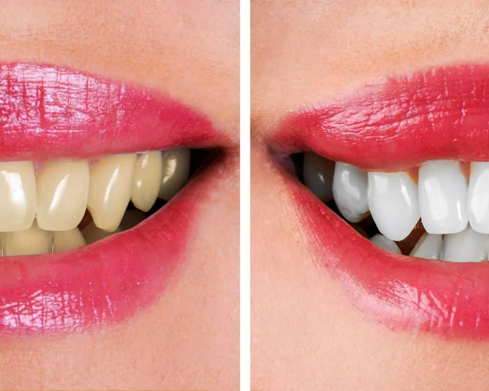 30998 brushing after whitening