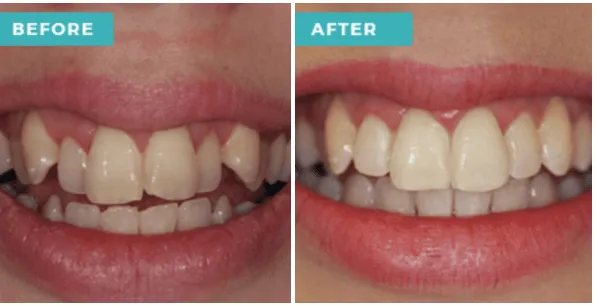 31010 in office teeth whitening