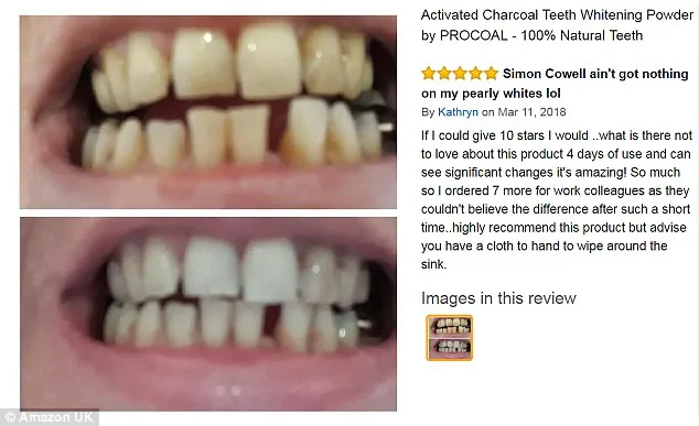 31017 in office whitening