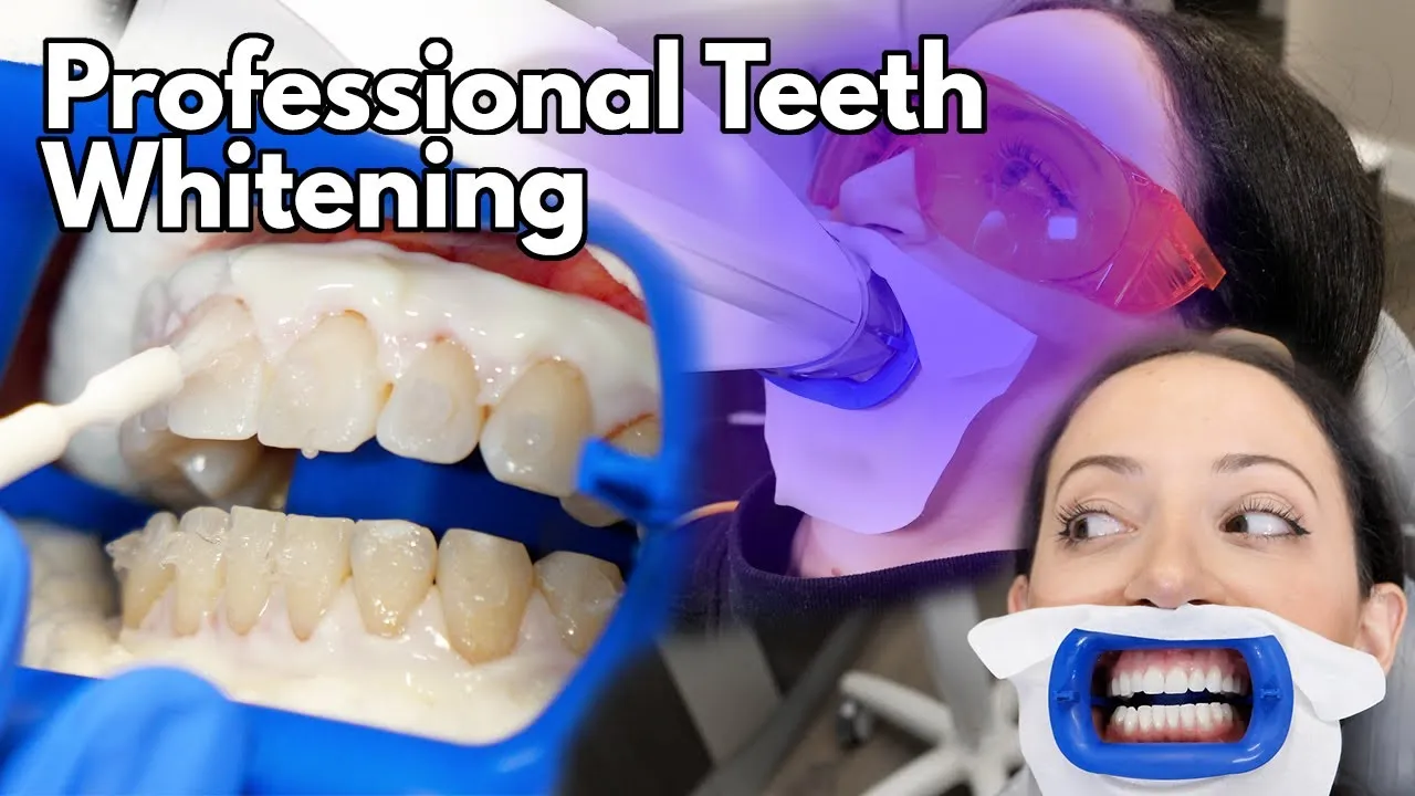 31033 in office teeth whitening
