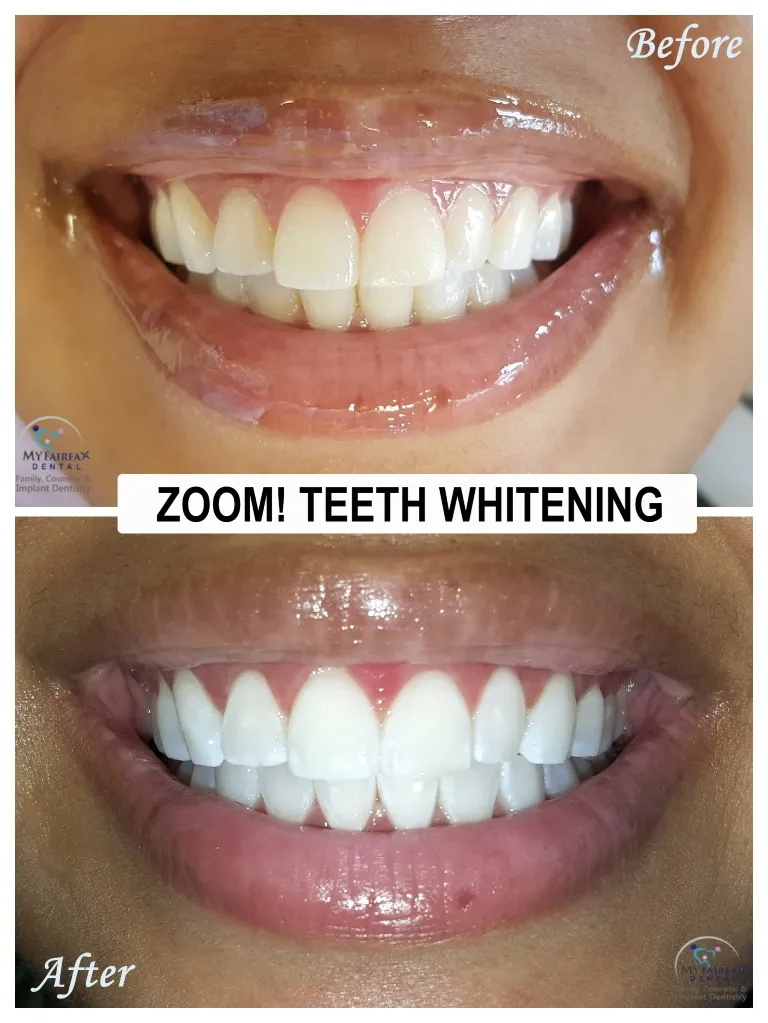 31033 teeth whitening agent