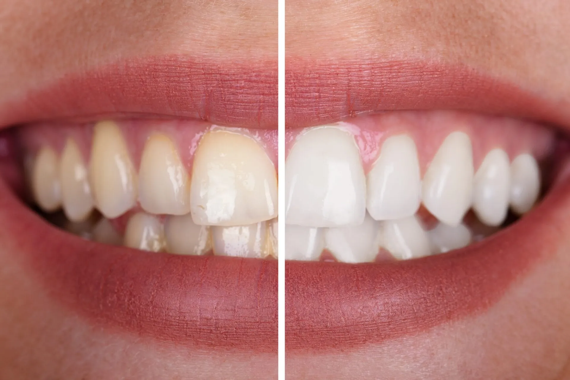31033 teeth whitening risks