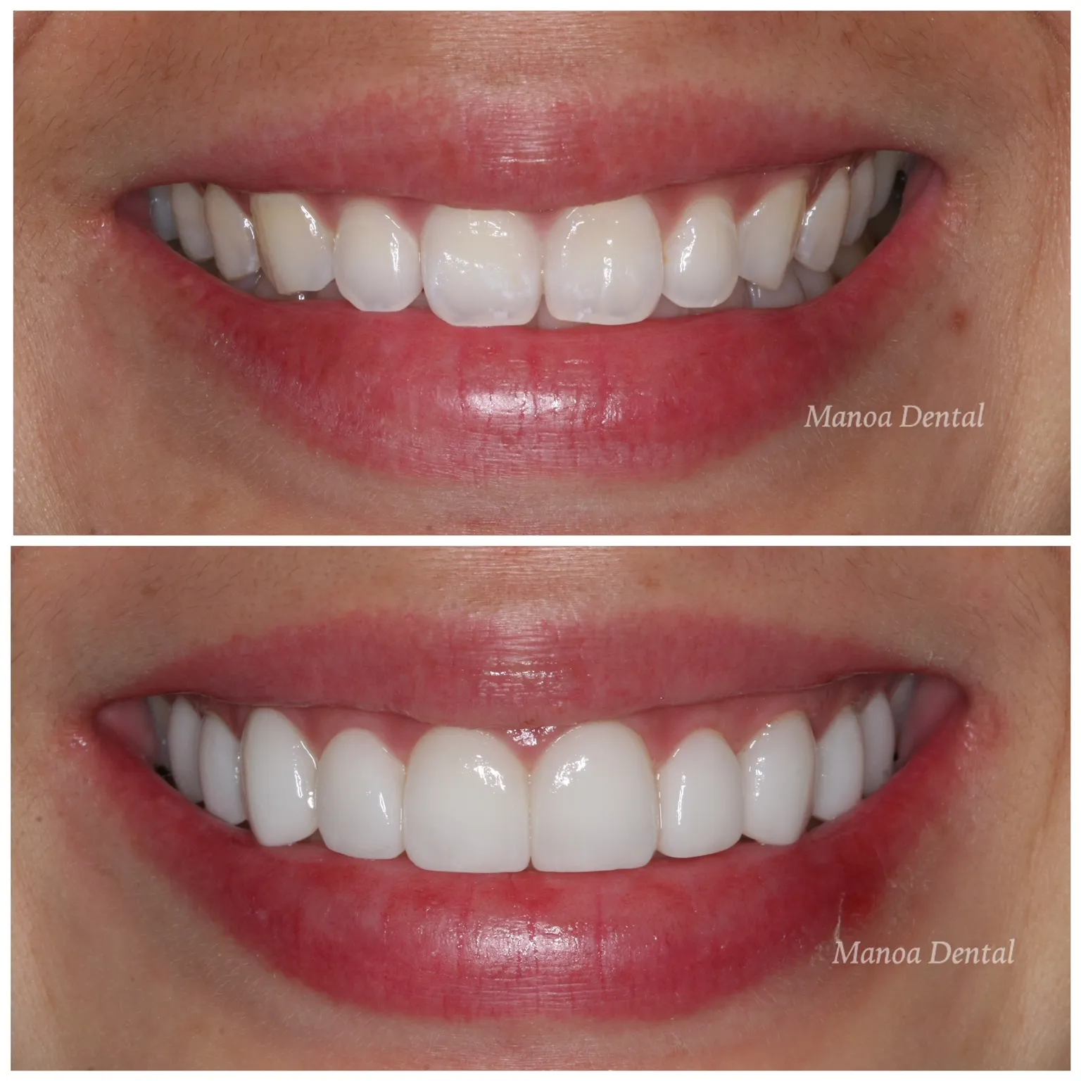 31042 lumineers teeth whitening aftercare