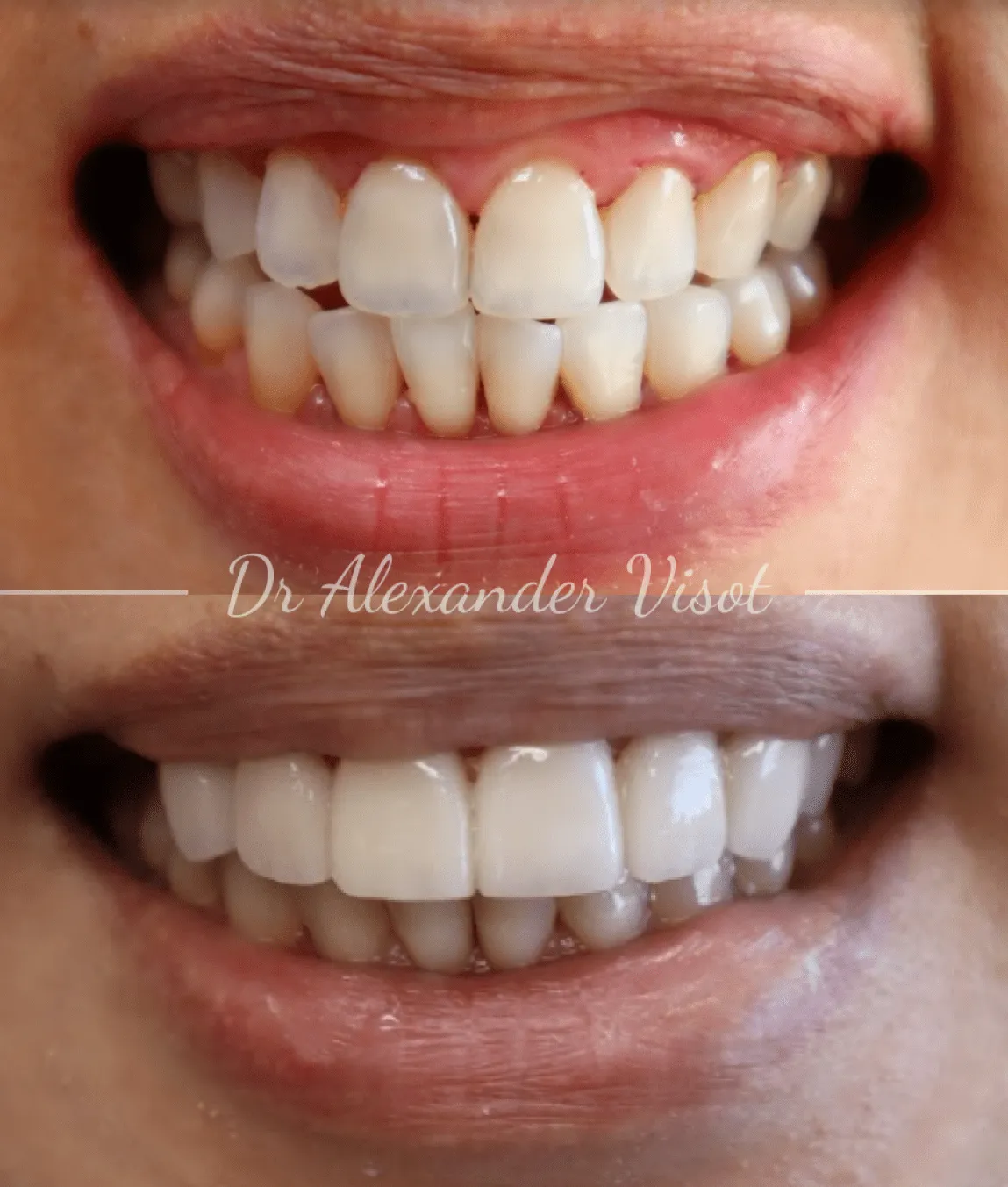 31042 lumineers teeth whitening application
