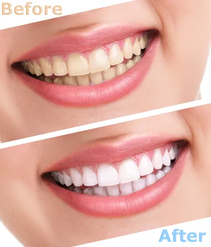 31042 lumineers teeth whitening before after