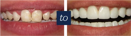 31042 lumineers teeth whitening consultation