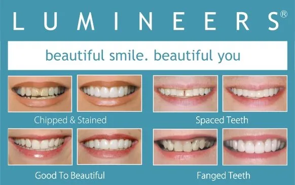 31042 lumineers teeth whitening preparation