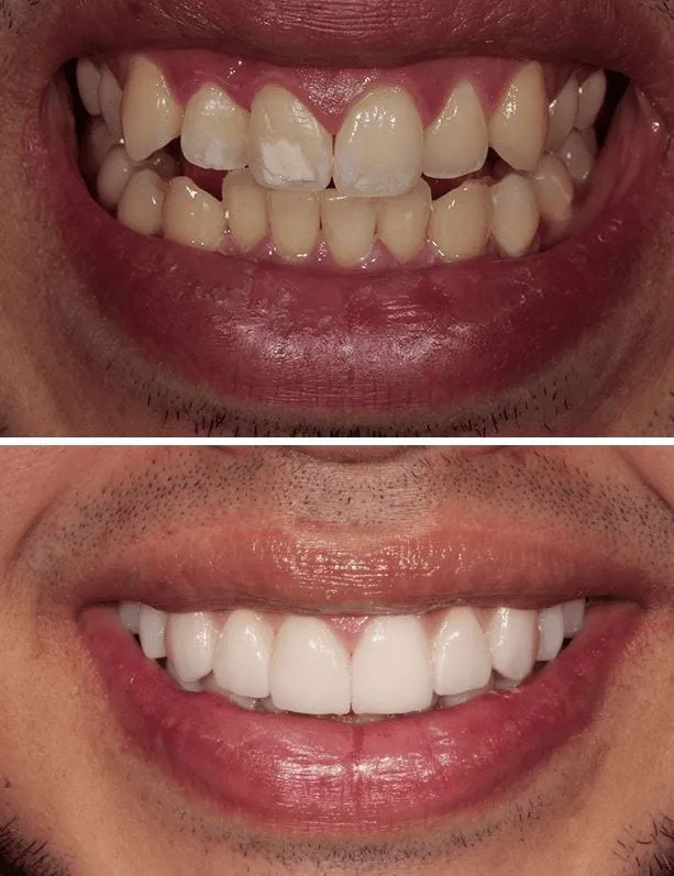 31042 lumineers teeth whitening smile