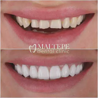/img/31042-teeth-whitening-alternatives.webp