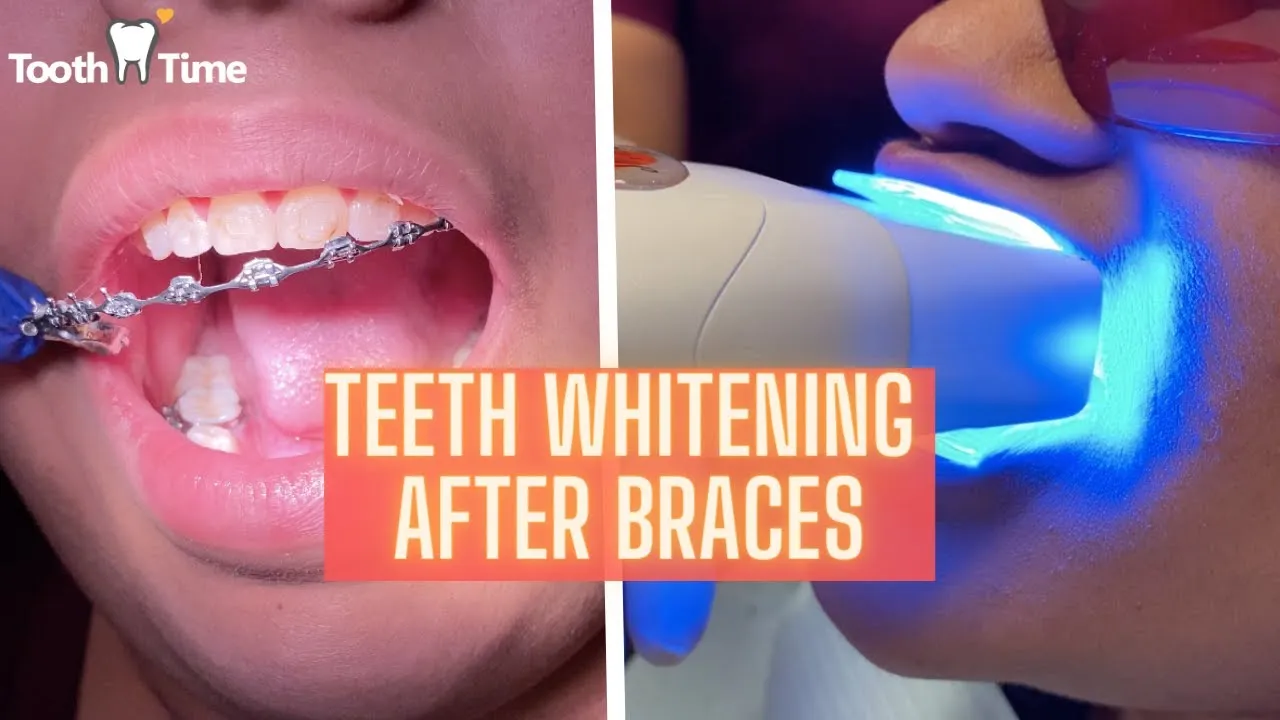 31045 professional teeth whitening
