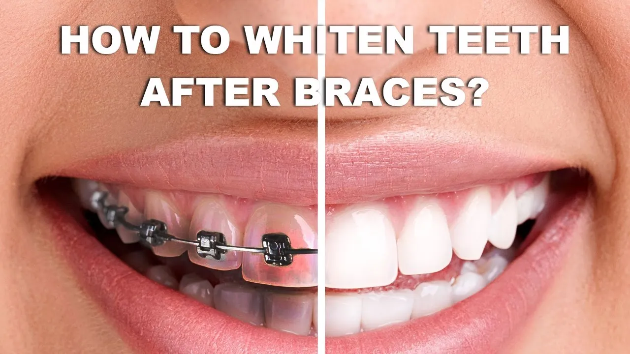 31045 teeth discoloration braces