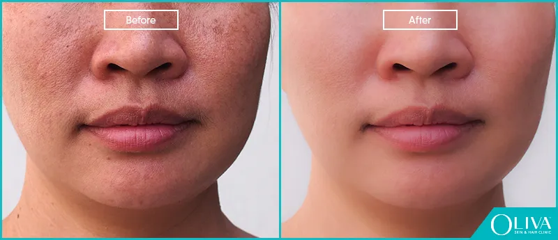 31046 face whitening chennai overview