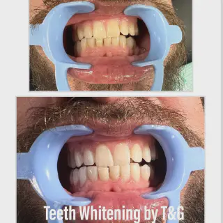 /img/31049-best-teeth-whitening-lv.webp