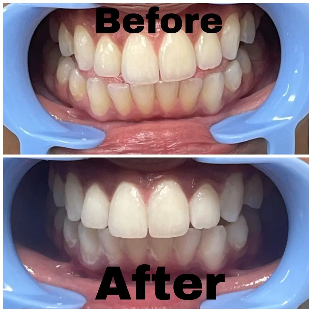 31050 honolulu teeth whitening before after