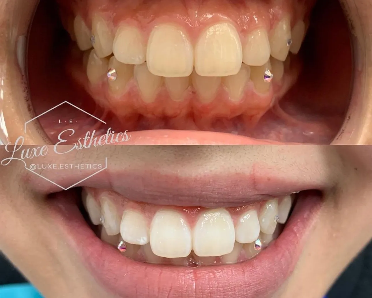 31050 in office teeth whitening