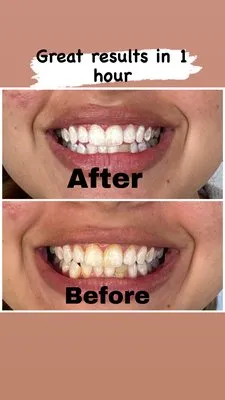 31050 teeth whitening strips
