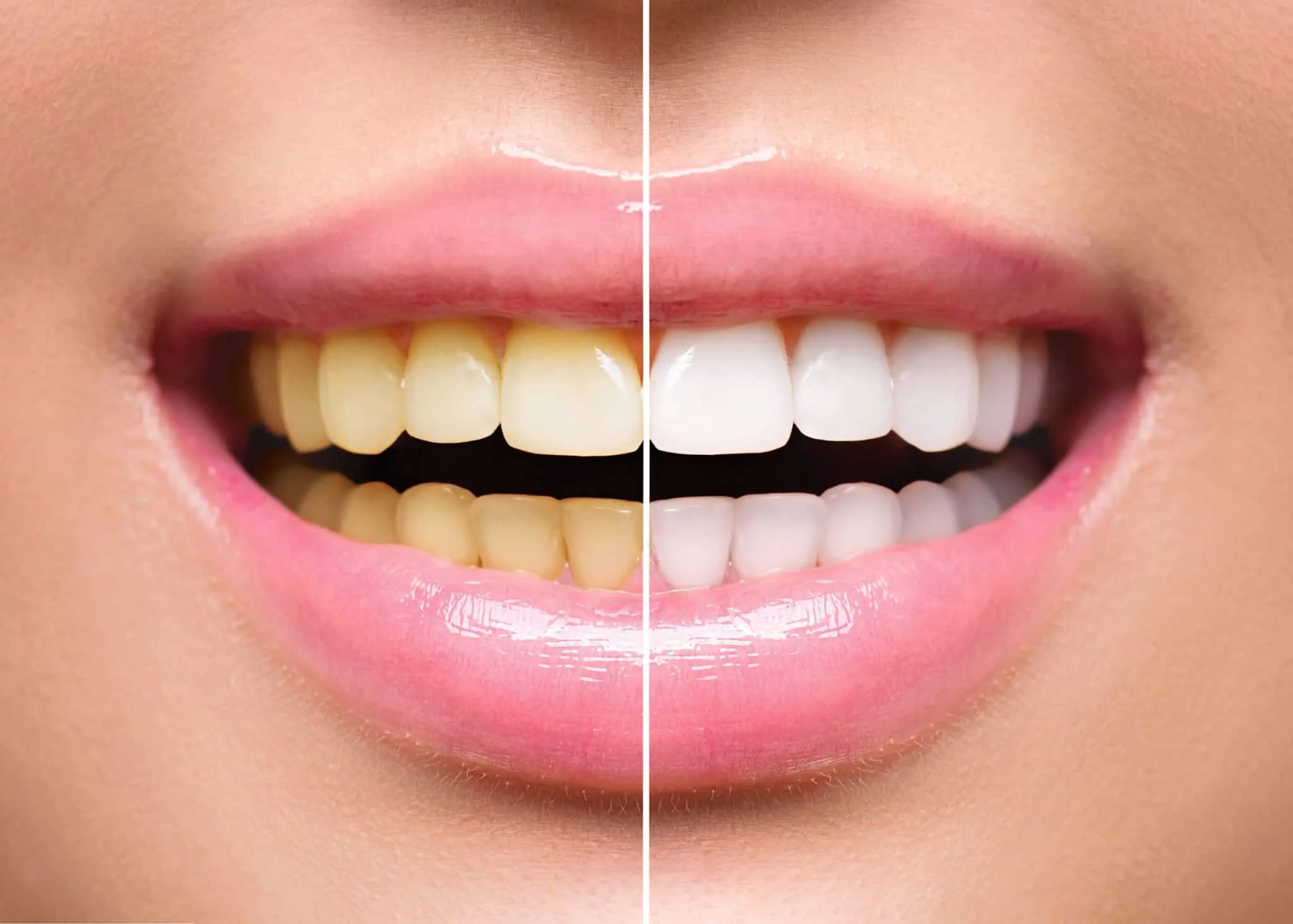 /img/31052-at-home-teeth-whitening.webp