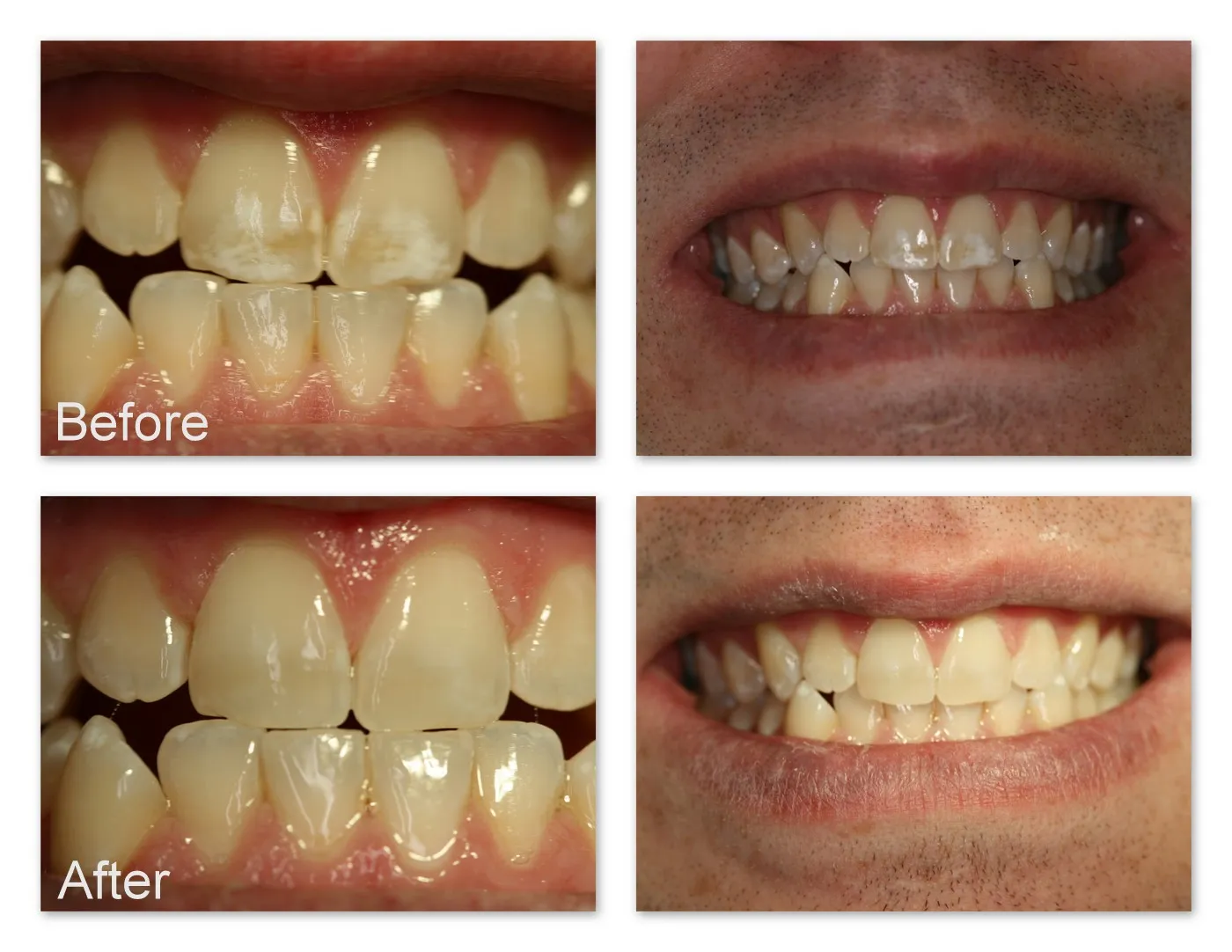 31052 professional teeth whitening