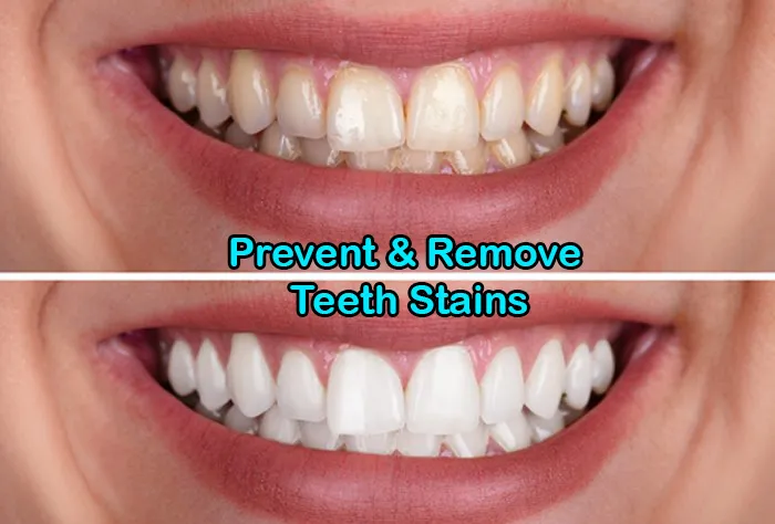 31052 teeth whitening process
