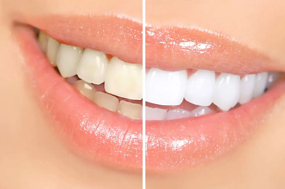 31056 teeth whitening cost