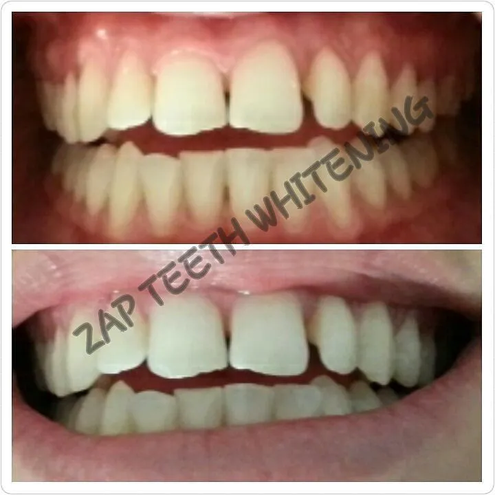 31056 teeth whitening process