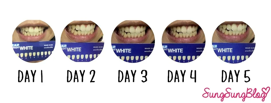 31056 teeth whitening results